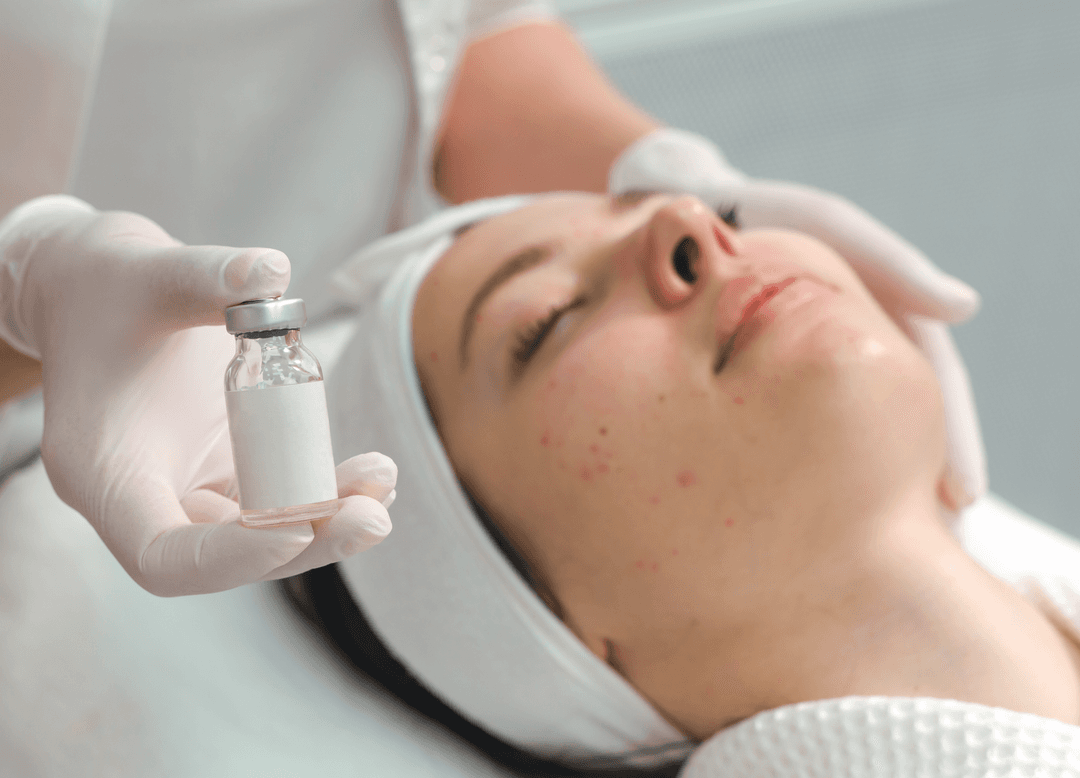 Acne Scar Laser