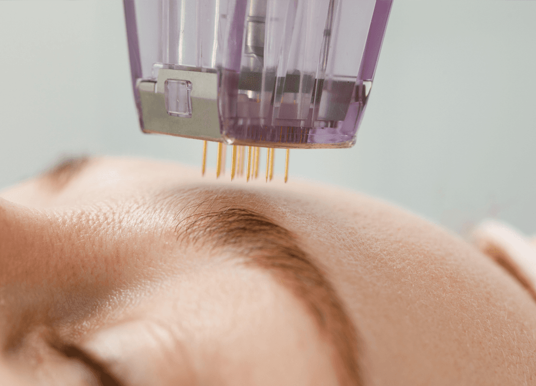 Micro Needling